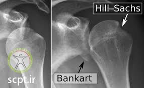 http://scpt.ir/uploads/shoulder dislocation bankart slap.jpg
