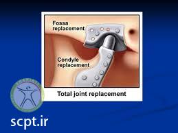 http://scpt.ir/uploads/temporomandibular disorder djd joint replacement.jpg