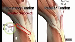 http://scpt.ir/uploads/two type graft acl.jpg